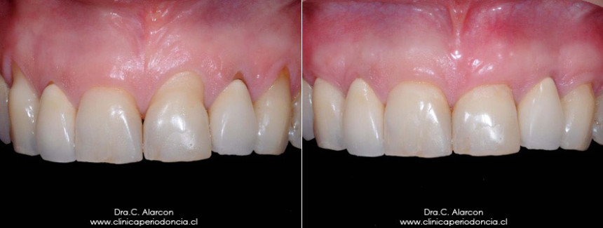 Regeneració gingival